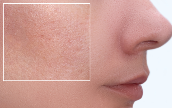 Літній догляд за жирною шкірою: уникнути блиску та запалень