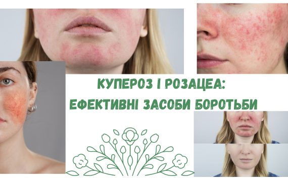 Купероз і розацеа: ефективні засоби боротьби