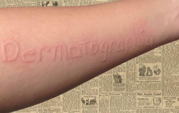 «Мистецтво малювати на шкірі» чи патологія? Все про дермографізм та догляд за реактивною шкірою.